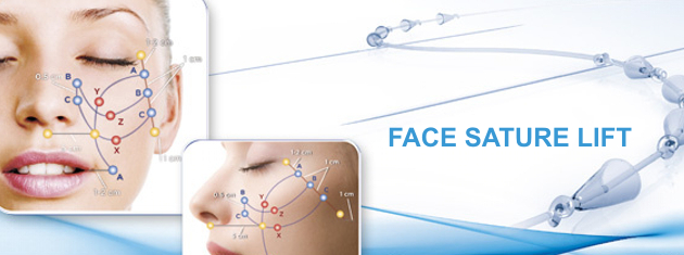 FACELIFTING SUTURES Silhouette soft lifting